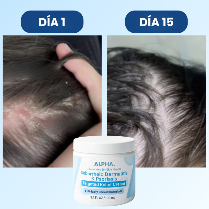 Crema para Dermatitis Seborreica y Psoriasis™